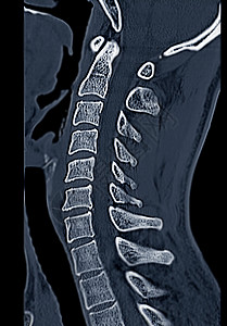 错位吻比较CT C脊椎或宫颈脊椎3D成像和人形图象扫描颈椎病病人技术考试诊断伤害骨科颅骨脊柱背景