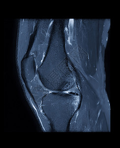 膝状藻与磁共振膝盖或膝合磁共振成像相比 可刺激脂肪抑制的轴 人形和冠状观察技术搅拌卫生十字放射科技术谐振考试扭伤软骨韧带背景