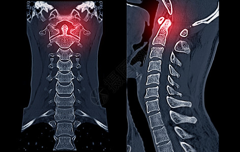 腺样体面容比较CT C脊椎或宫颈脊椎3D成像和人形图象脖子病人颅骨疝气考试痛苦脊柱创伤椎骨放射科背景
