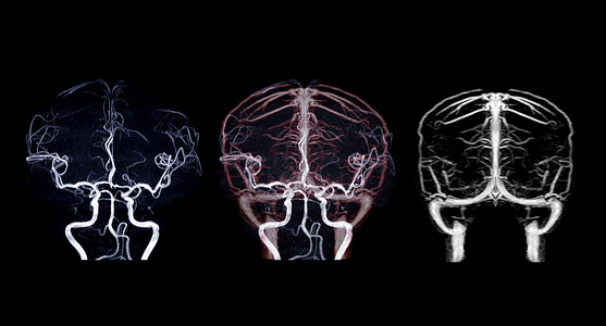 MRA脑和MRV脑诊断静脉中风速度动脉流动血管谐振放射科鼻窦背景图片