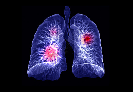 肺部CTCT 肺3d 肝脏成象器官结节屏幕病人胸椎心脏病学扫描诊断心血管哮喘背景