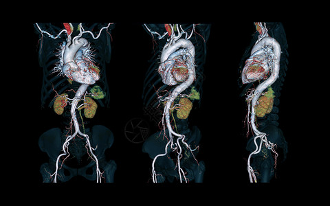 肺血管CTA 整个 aorta 3D 以黑色背景显示图像 用于检测动脉动脉瘤诊断射线插图断层照相图表心室放射科监控技术背景