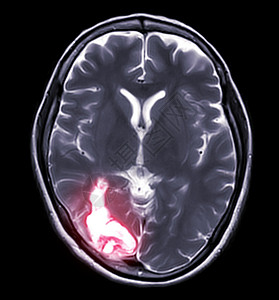 轴向核磁共振大脑轴心T2W视图显示肝炎病背景