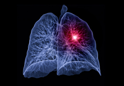 肺部CTCT 肺3d 肝脏成象肋骨电影癌症肺炎解剖学哮喘电脑疾病结核科学背景