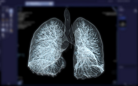 CT 胸腔或肺3D为诊断结果提供图象 肺结核 结核病和宫颈19癌症结核疾病心脏病学药品解剖学电脑放射科断层结节背景