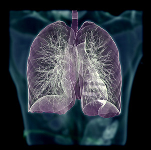 隔膜CT Chest 或 Lung 3D 在模糊的人体背景上拍摄图象 用于诊断肺结核 结核病和共生19背景