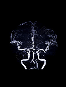 MRA脑和MRV脑颅骨流动医院放射科中风肿胀大脑疾病谐振射线背景图片