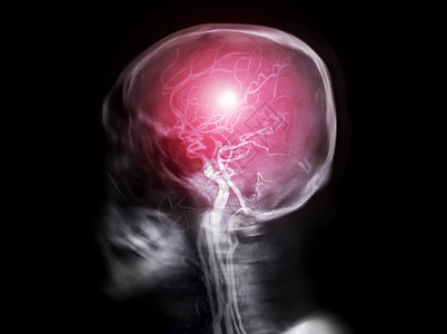 思维图人体头骨横向视图与MRA脑图相融合的Skull X射线图像背景