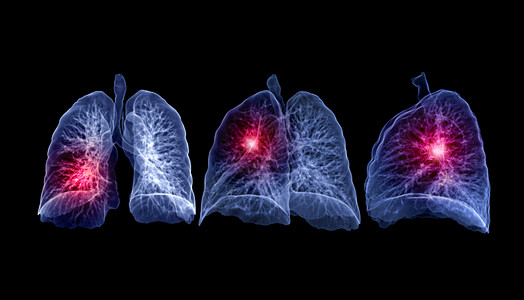 肺结节3d渲染部分高清图片