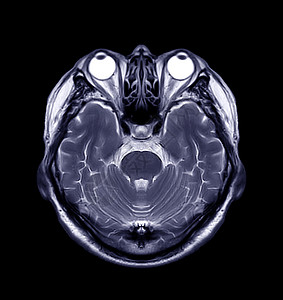 大脑核磁共振药品射线诊断颅骨血管病人出血中风谐振动脉图片
