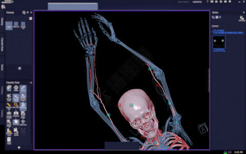 手臂强度CTA 胸动脉或上部外缘的CT扫描或模糊屏幕上的臂3D成像图像背景