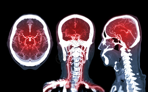 脑血管造影收集CTA大脑或CT脑血管学 比较Mip Axial Conronal和Sagitatal视图的大脑对比 以探测脑动脉背景