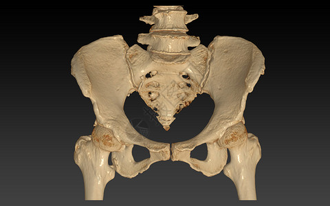 髂骨CT 骨盆骨骼扫描 两个臀部连接 3D 将图像隔离在黑色背景上背景