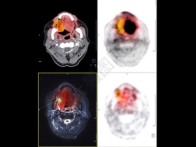 正电子PET CT Neck图象显示PET CT扫描仪的CA 鼻喉或鼻腔癌ct扫描癌症医院机器放射科考试专家人脑科学背景