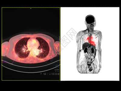 PET 为检测肺癌复发而比较轴心 冠状腺的胸部或胸部扫描图像背景