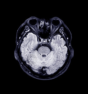 大脑核磁共振药品医院疾病诊断射线放射科出血头晕中风血管图片