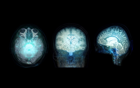 核磁共振成像以大脑为主的  Skull  透明图像用于医学背景概念脑血管病人颅骨射线核磁共振医院疾病药品治疗动脉背景