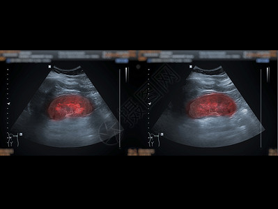 超声波上腹部显示肾脏用于肾脏疾病筛查图片