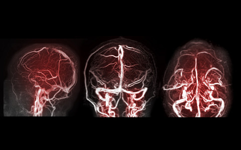 颅内出血MRV 大脑脑部或磁共振的脑神经系统 用于脑静脉排水中的异常现象背景