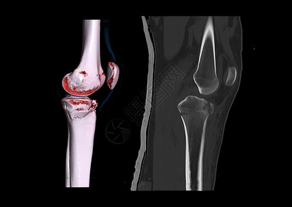 骨折手术比较 CT 膝关节 3D 渲染图像横向视图和 CT 膝关节 2D 矢状视图隔离在黑色背景上 显示胫骨骨折背景