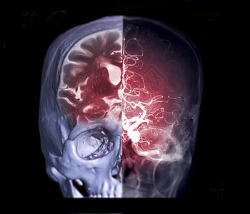 CT MRI 大脑和脑血管造影图像前视图的融合图像显示大脑和大脑动脉的解剖背景