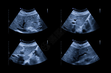 超声波上腹部显示肝脏和胆囊 用于筛查肝细胞癌和凝石诊断解剖学病人积液回声扫描检查脓肿胰腺卵巢背景