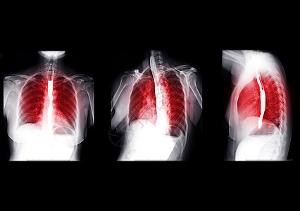 消化道溃疡Esophagram的收藏品手术学习胃肠道食管病变气体外科钡餐诊断疾病背景