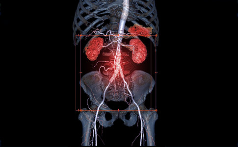 CTA 全Aorta 3D翻译高清图片