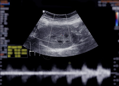 上腹部超声波显示肾脏小腹卵巢解剖学黄疸病人脓肿考试积液超声疾病背景图片