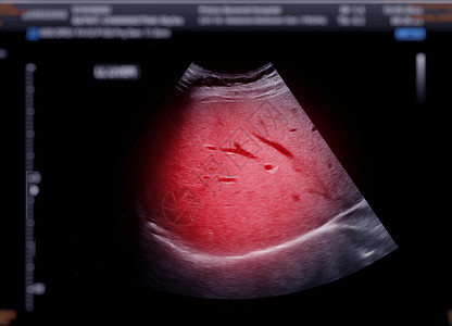 上腹部超声波显示肝脏超声脓肿回声药品检查胰腺小腹腹痛异质扫描背景图片