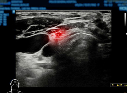 光谱学甲状腺癌医疗的高清图片