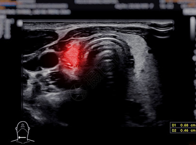 甲状腺瘤用于甲状腺诊断的甲状腺超声波光谱学扫描器脖子癌症医院程序考试甲减甲状腺炎技术扫描背景