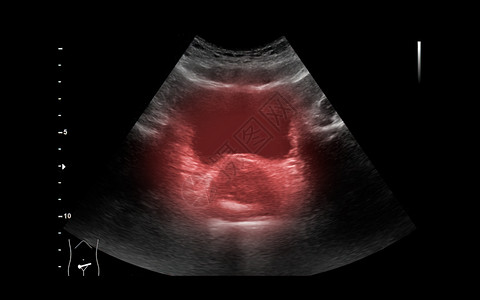 泌尿结石用于检查肾脏和膀胱疾病的尿囊或库布的超声波疼痛尿液学习尿道肾囊肿医疗脓肿乳突子宫医院背景