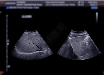 上腹部超声波显示肝脏身体卵巢胰腺扫描腹痛脓肿异质回声胆囊怀孕图片