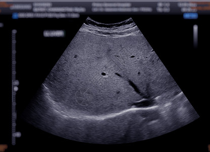 上腹部超声波显示肝脏扫描药品诊断回声卵巢胰腺检查异质解剖学象限图片