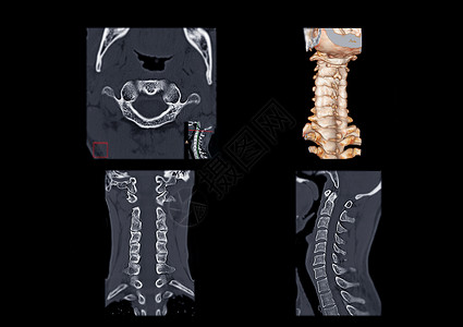 腺样体肥大CT C-Spine或子宫颈脊椎轴视图 3D成形图像 Corona和侧面视图i背景