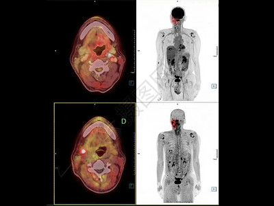 缓速器PET CT Neck图象显示PET CT扫描仪的CA 鼻喉或鼻腔癌专家骨骼神经鼻咽部ct外科诊断学家病人速器背景