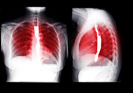 Esophagram的收藏品癌症胃肠道疾病支架化合物手术电影学习外科钡餐背景图片