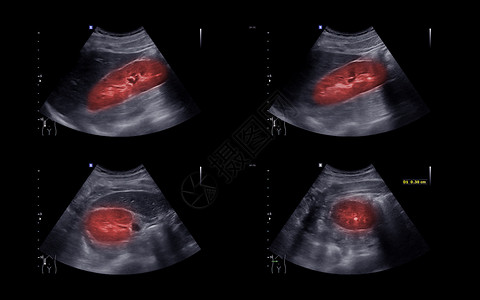 泌尿结石用于检查肾脏和膀胱疾病的尿囊或库布的超声波调查皮层胶囊石头扫描器官药品子宫尿道医院背景