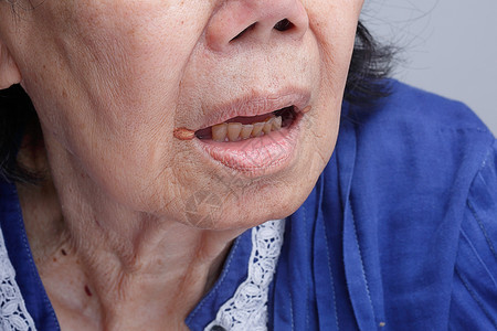 疱疹性咽颊炎角天颈炎是嘴唇经常发炎的一种方式疾病水疱女士药品医疗中心细菌身体香脂老年背景