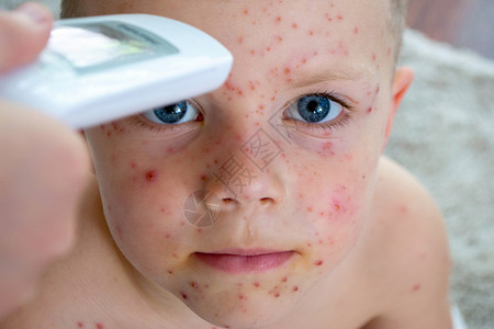 斑皮肤自然接种疫苗 传染性疾病童年传染病孩子女孩们病株女婴药品病人发烧生活方式背景