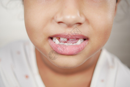 牙齿畸形的女童孩子保健卫生牙科生长口服牙医白色图片