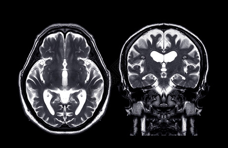 轴向MRI 脑核磁共振二氧化T2和日冕t2f技术背景