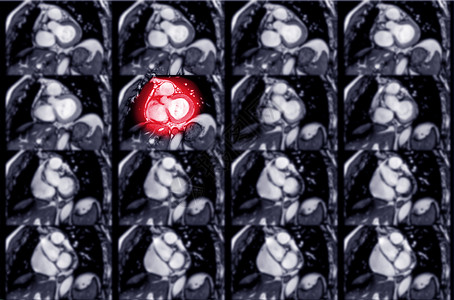 心肌梗塞或心肺复苏诊断核磁共振中风谐振射线扫描胸部心律失常动脉心电图图片