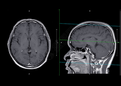 MRI 脑轴和人文平面 带有对比度高清图片