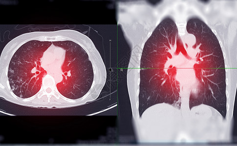 肺部呼吸CT 肺轴心和射线视图的切片或切片扫描背景