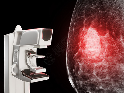 X射线数字乳房X光照相机和乳房X光照相机 用于隔离在黑人背景下的妇女的宫颈癌诊断背景