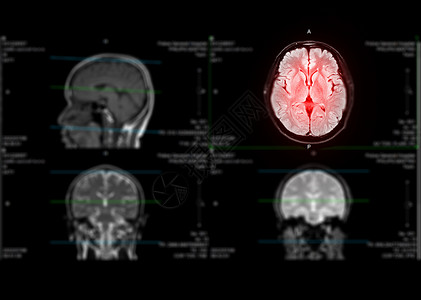 用于检测中风疾病和脑肿瘤及细胞细胞的核磁共振大脑轴心能力背景图片