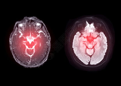 核磁共振成像用于检测中风疾病以及脑肿瘤和细胞的 MRI 大脑轴心扩散图像背景