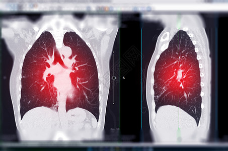 肺部CTCT 肺科和人表的胸腔或胸部扫描背景